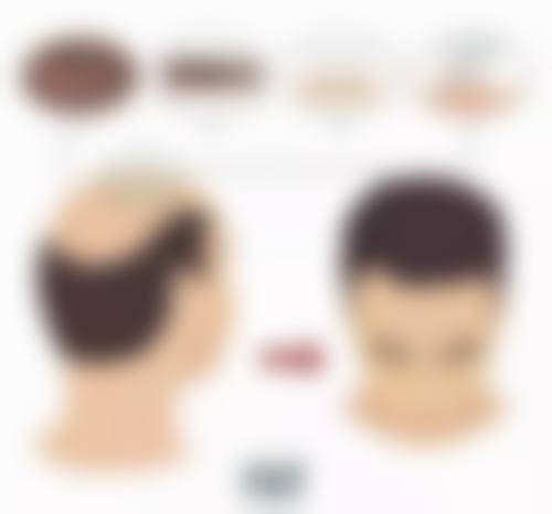 优质修复方案：改善耳软骨隆鼻取出后鼻部形态