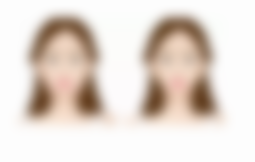 隆鼻两年遭撞击:耐心修复,美丽依旧