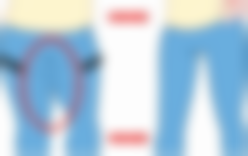 变得更美秘诀：修复时间受多因素影响，3 - 6个月差异有因