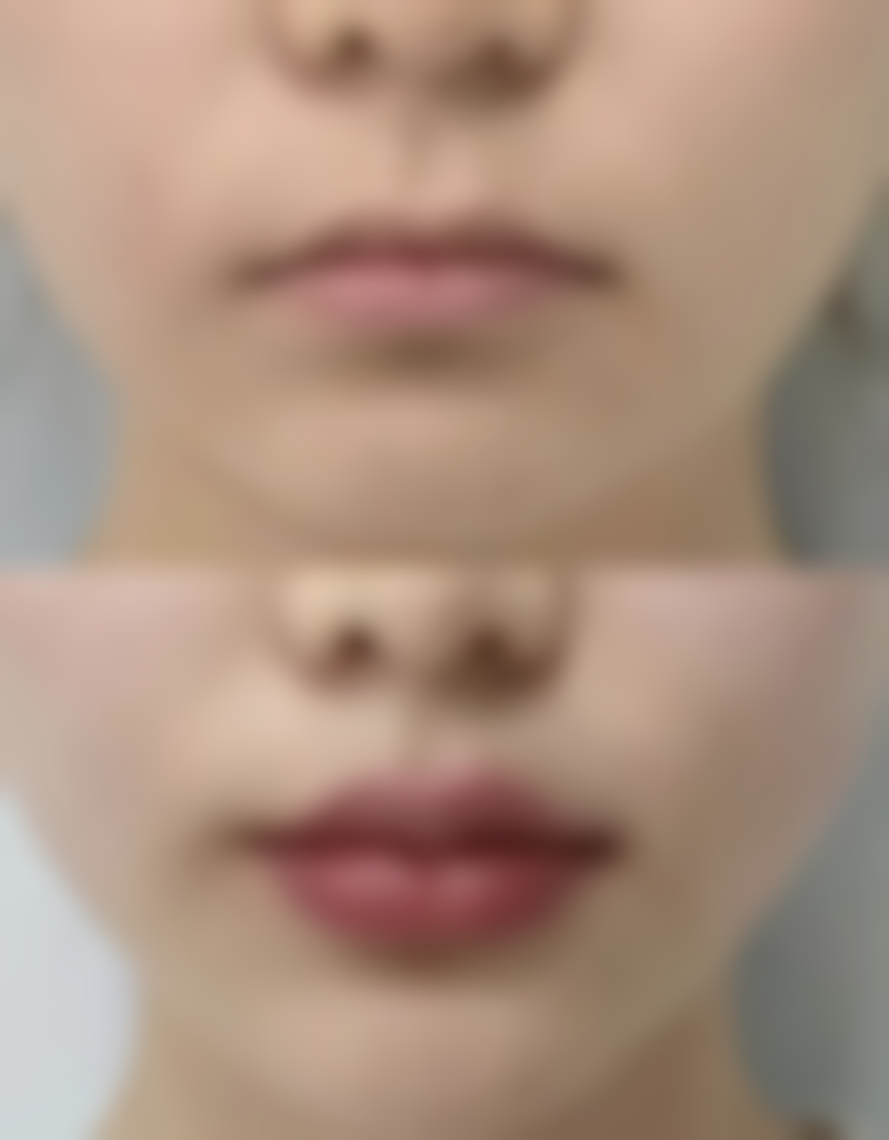 隆鼻两年遭撞击影响几何？看撞击力度、症状与专业修复如何护航美鼻