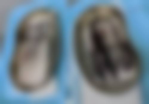 韩式双眼皮价格究竟几何？影响价格的因素有哪些