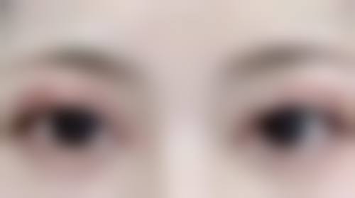 自体脂肪丰太阳穴：安心取材无后顾之忧