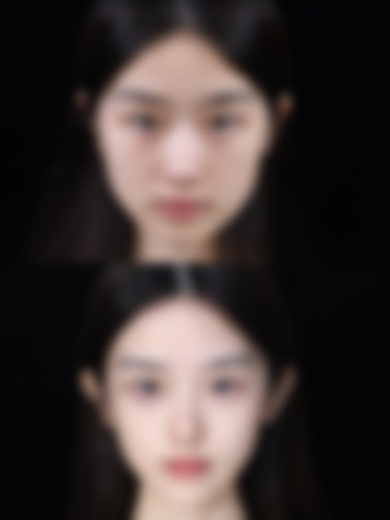 自体脂肪丰太阳穴：选择合适医院开启美丽之旅