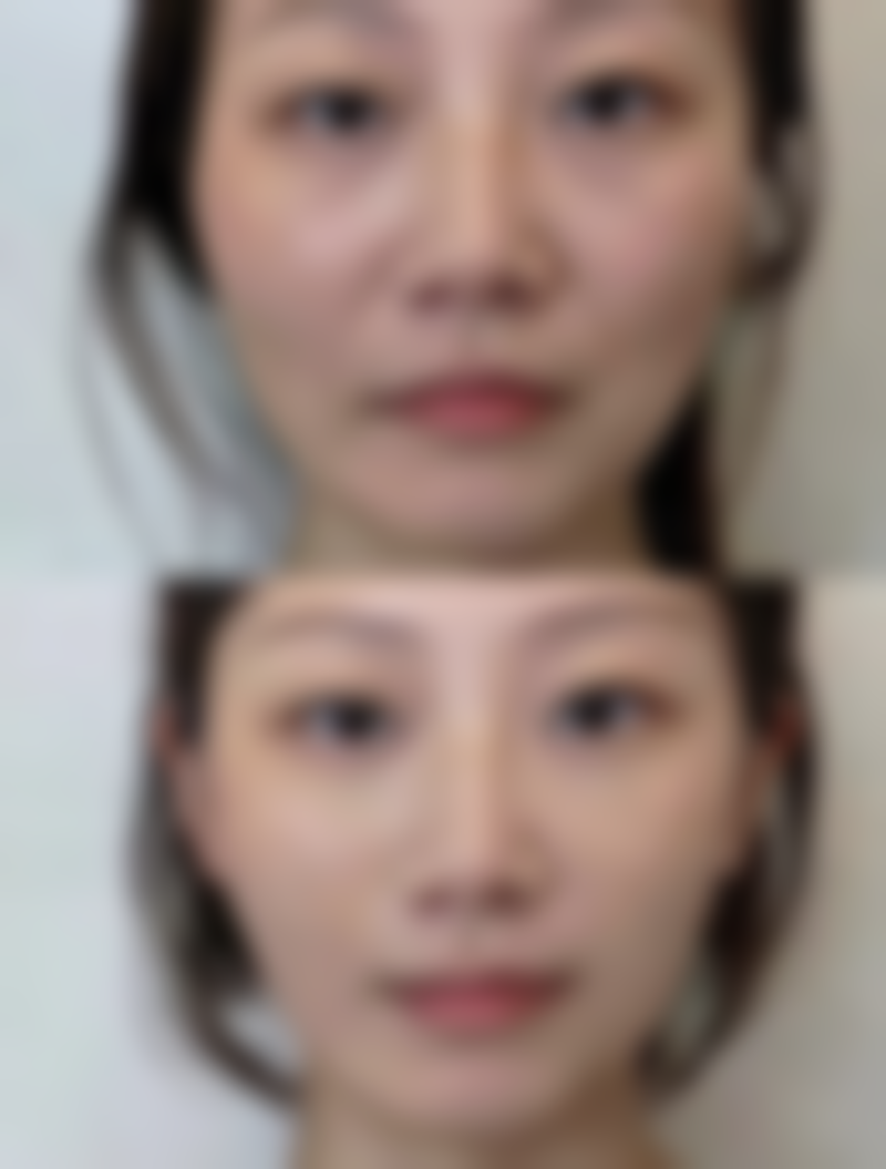 张正强面部整形实例