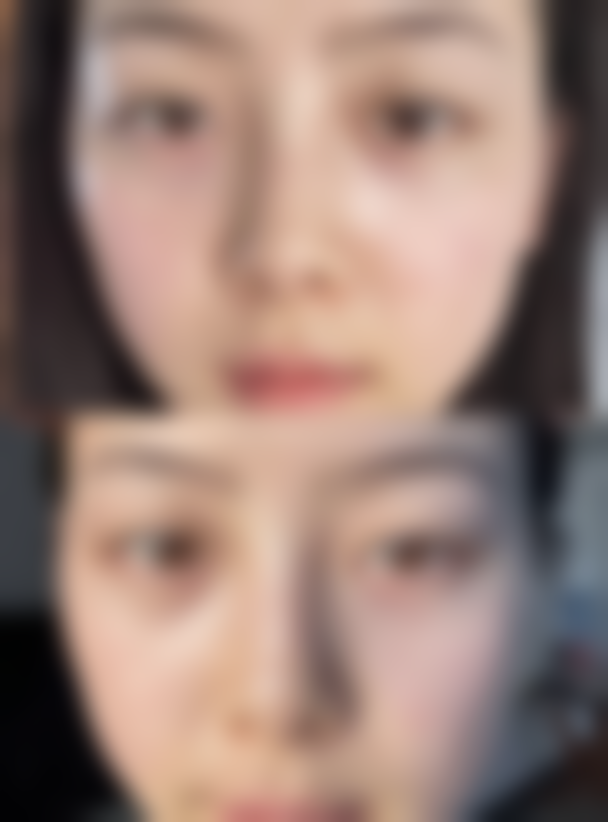 自体脂肪丰太阳穴优势显著：自然触感、持久效果，助你重塑饱满面部轮廓