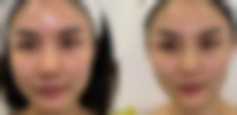 眼周美学注重协调，整体抗衰方案特别关键