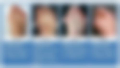 脂肪隆胸操作大揭秘：适合人群与美好成效展望