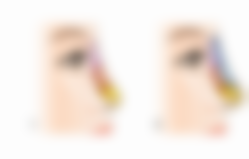 脂肪隆胸操作大揭秘：保护脂肪高存活的秘诀