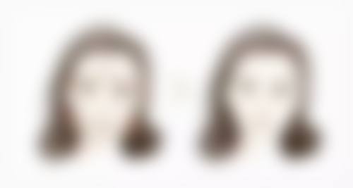 药物治疗显神通，辅助淡化油烫伤疤痕黑