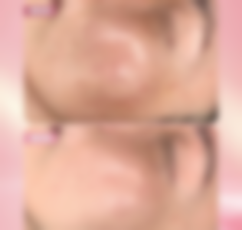 假体隆胸后能否喂奶？多数可正常哺乳，选正规医院兼顾外形与哺乳功能 