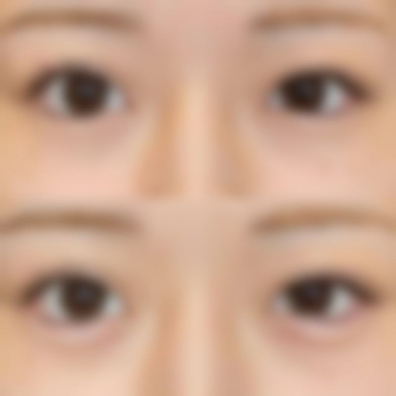 丰太阳穴好方法大揭秘：玻尿酸、自体脂肪等多方案，兼顾持久与自然美 