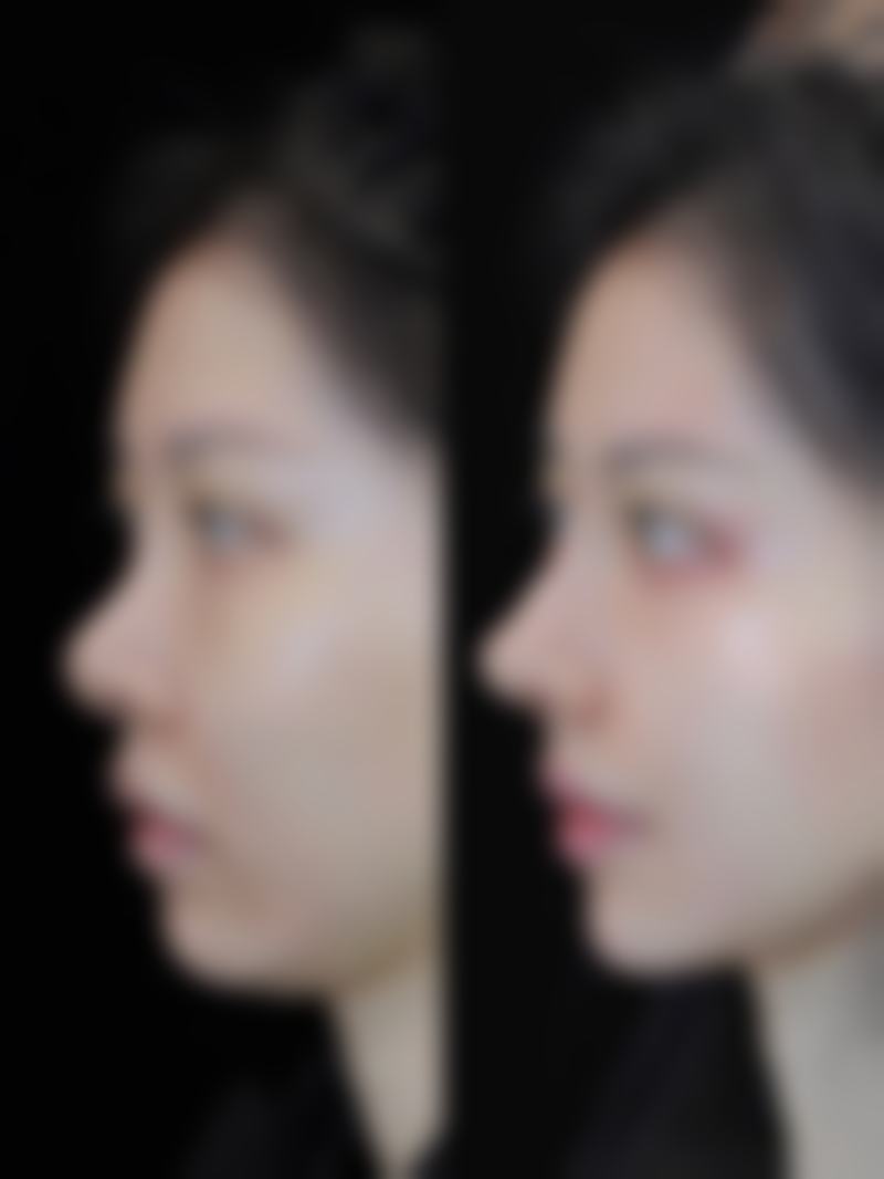 张正强面部整形实例