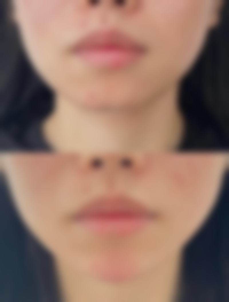 怎样极速消除眼袋？术后护理不能忘