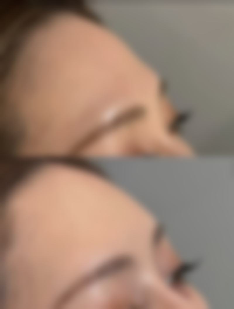 日常护理小妙招，淡化油烫伤疤痕黑印记