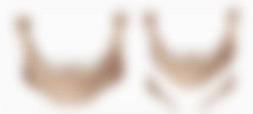 增生性疤痕治疗之激光技术揭秘，刺激再生改善疤痕