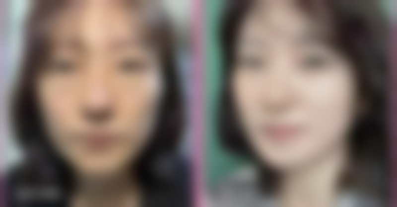 增生性疤痕治疗之综合护理揭秘，多管齐下告别疤痕困扰