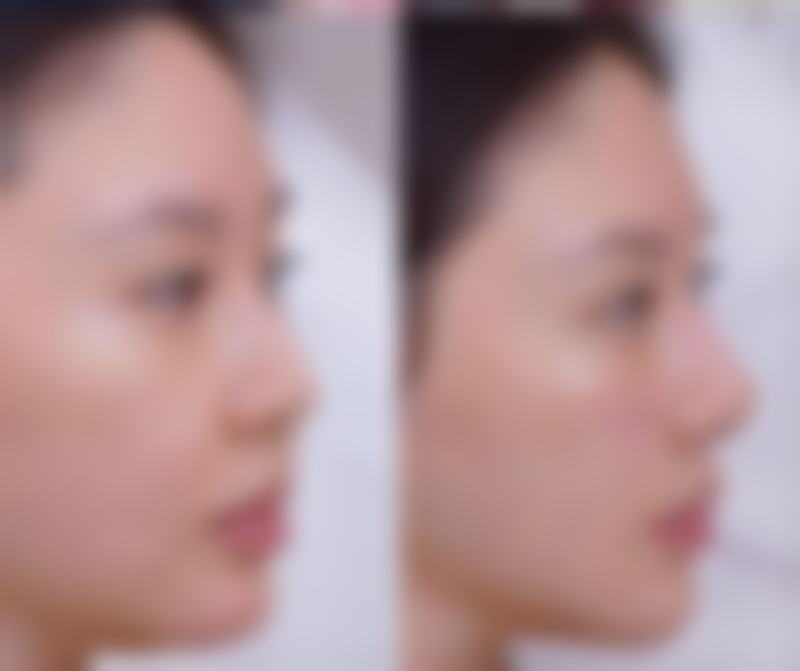 20年陈旧疤痕消除：专精医院的重要性