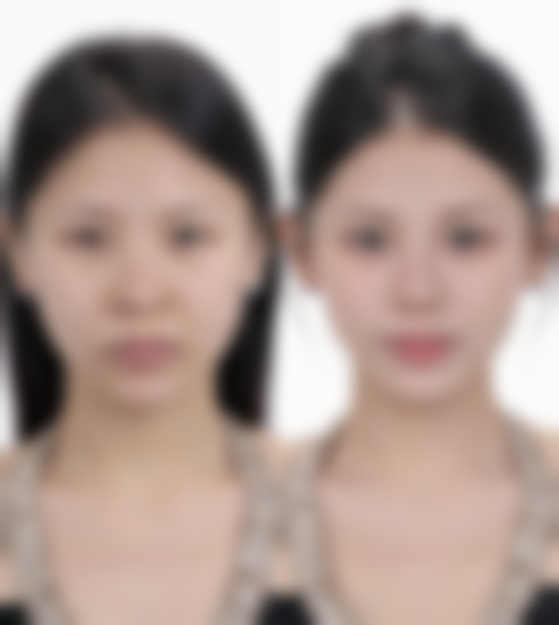 隆胸后取出假体胸部会变形吗？揭秘影响因素与正规医院助力恢复秘诀 