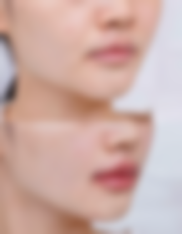 埋线双眼皮成效究竟如何？快速修复展现魅力