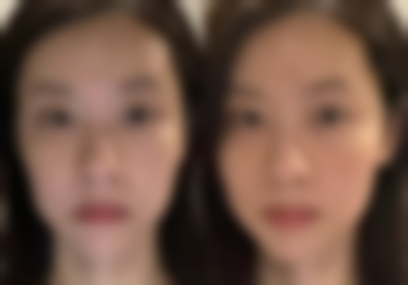 双眼皮拆线后眼角小疙瘩：风险提示与及时就诊