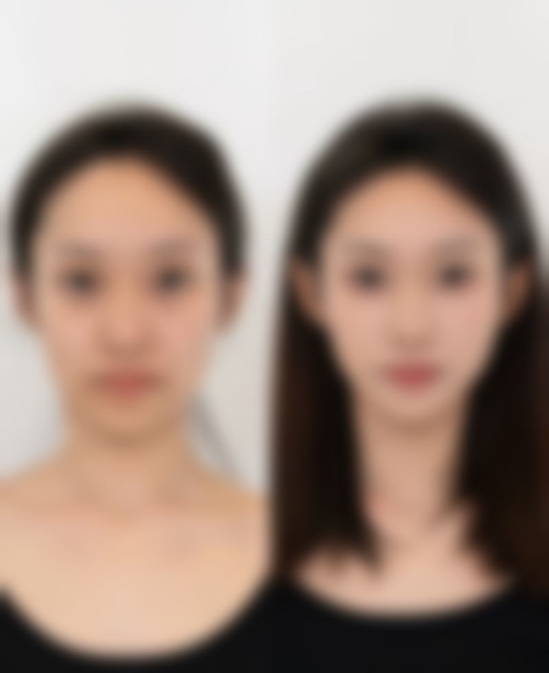 药物治疗疤痕性青春痘咋样？早期表浅疤痕有成效