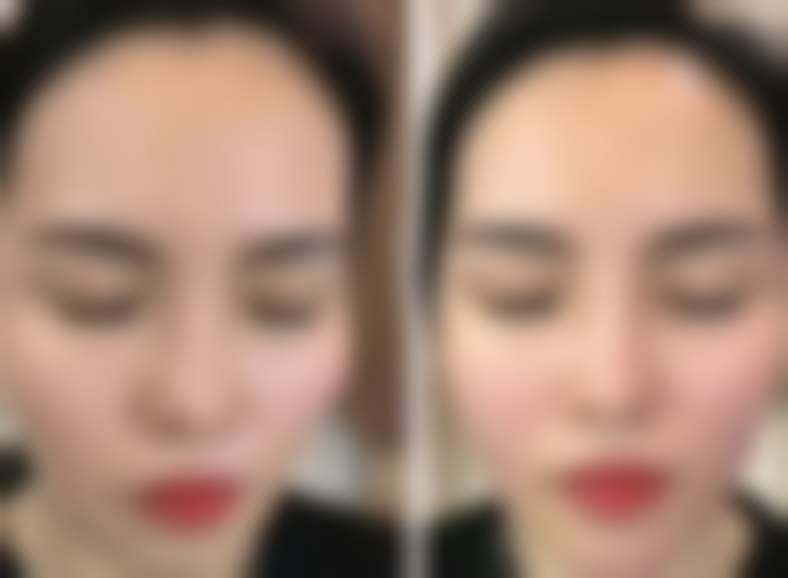 双眼皮拆线后眼角小疙瘩能否恢复？揭秘正常增生与异常情况的修复秘诀 