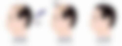 如何修复疤痕效果好？分型处理、联合治疗，正规机构专业方案助您焕新肌肤 