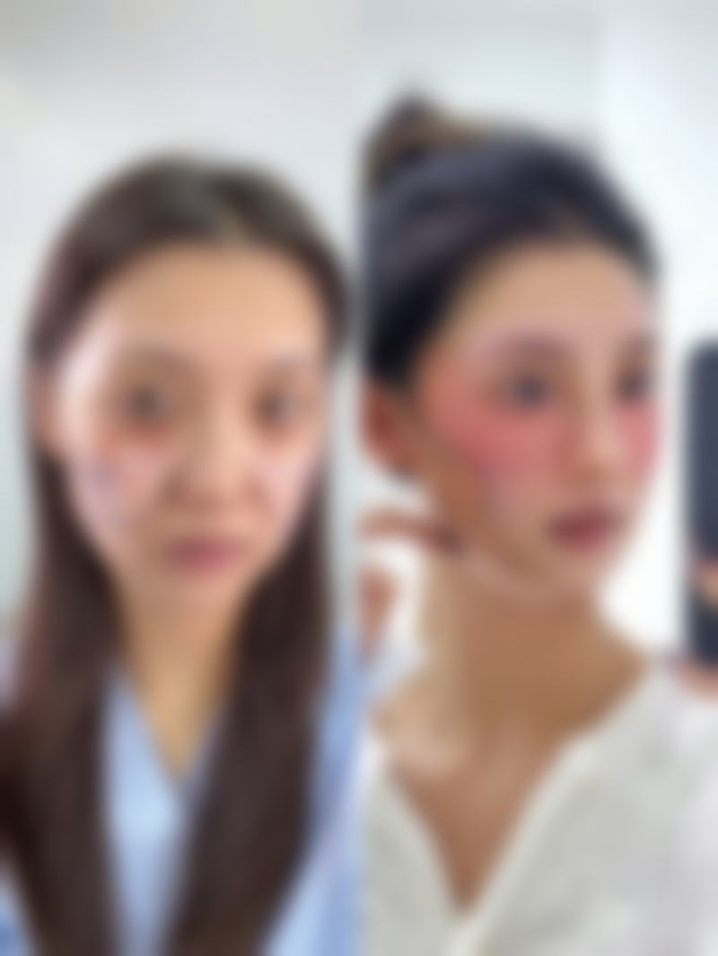 双眼皮埋线线断裂概率几何？优质线材、精湛技术与精心护理助你安心成型 