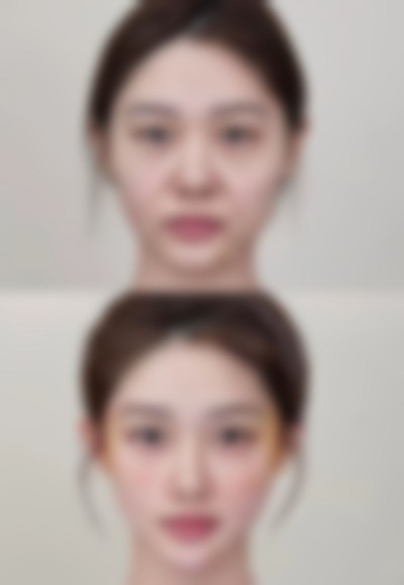 双眼皮埋线线断裂概率几何？不错技术是强力支撑