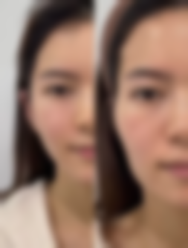 肿眼泡不割双眼皮抽脂:选对医院特别重要