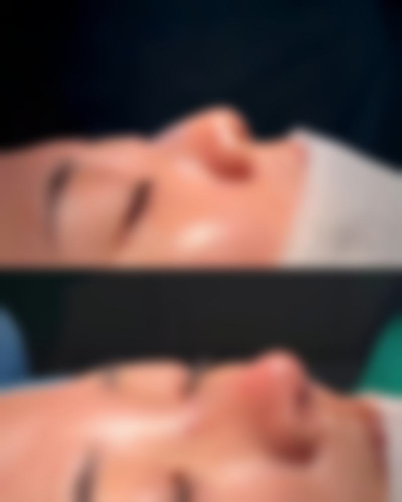 手术疤痕增生如何治疗？多阶段方案定制，助您重塑平滑肌肤、恢复美观功能 