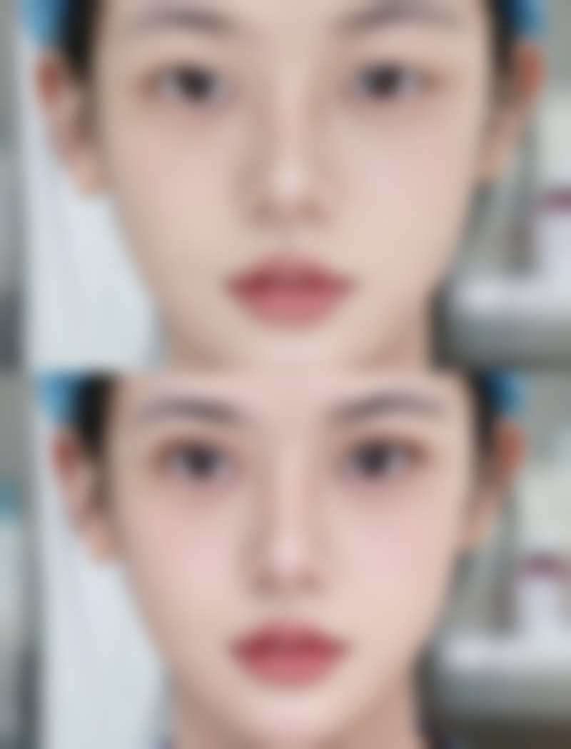 割双眼皮多元增效方案大推荐