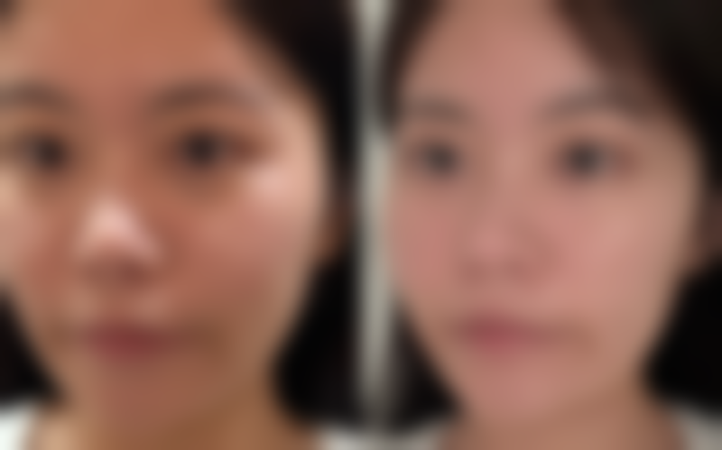 每天眼部按摩能否去眼袋？揭秘其对水肿型眼袋的辅助改善及正规医美解决之道 