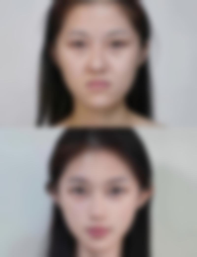 脸上痤疮疤痕怎么去除？多种医美手段结合科学护理，助你恢复平整肌肤 