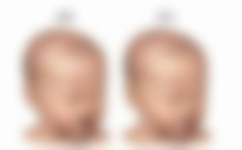 不同类型疤痕，针对性治疗方案