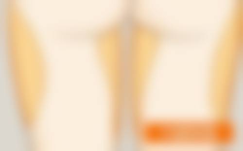 眼袋重度莫焦虑！重度情况看这里