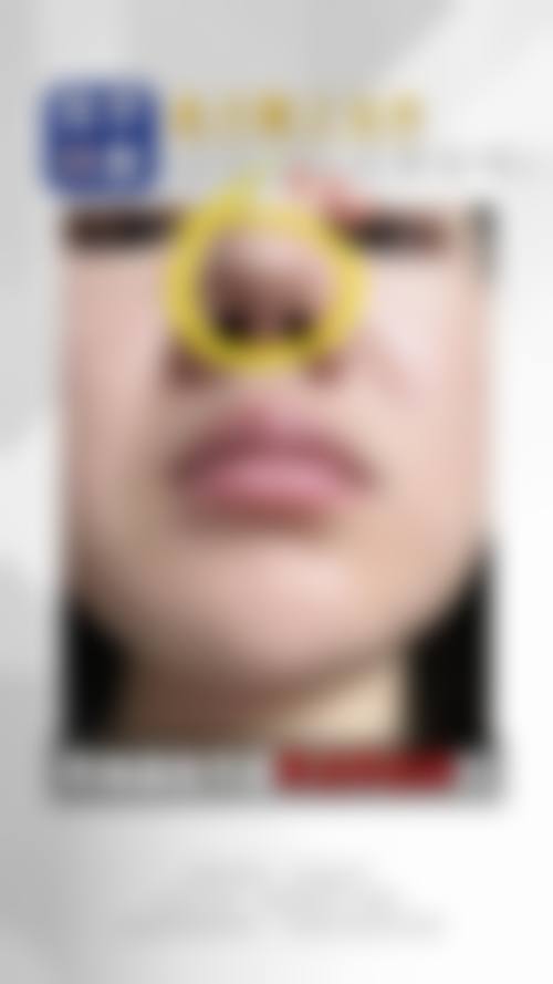 李祥仟眼部整形手术实例