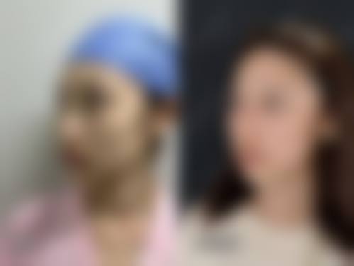 周军臣精细化雕刻立体隆鼻实例