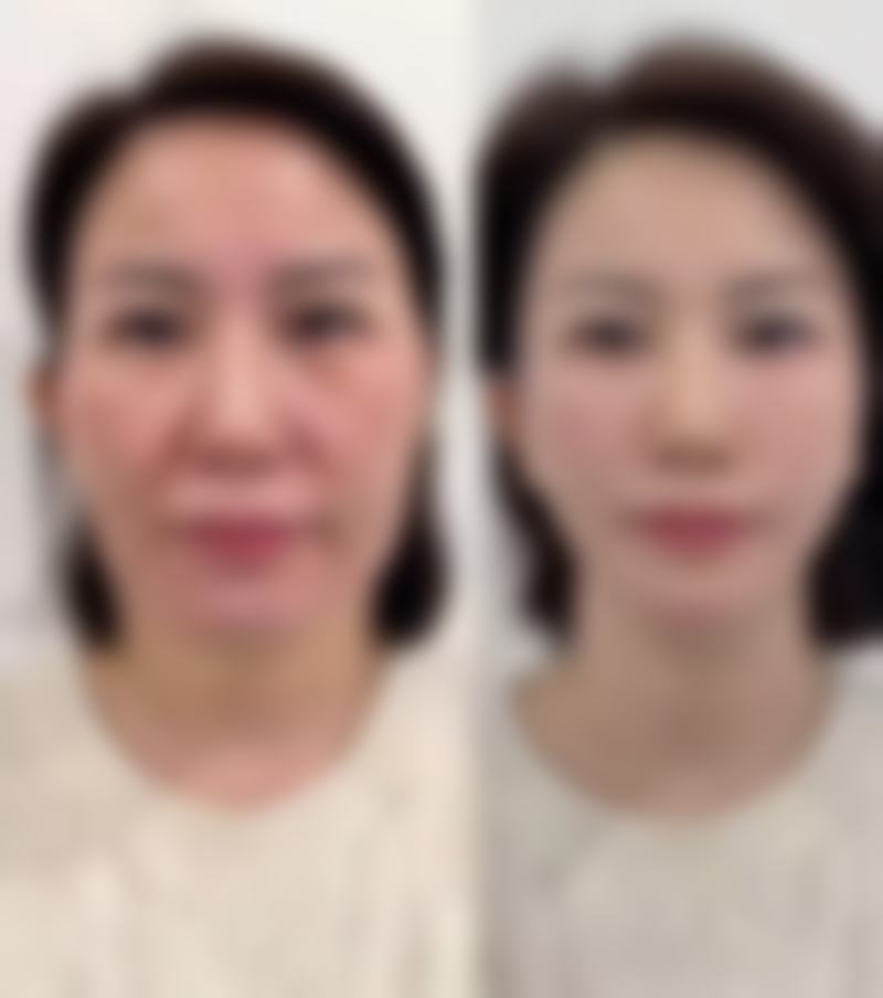 四、深圳初笙整形医院实例