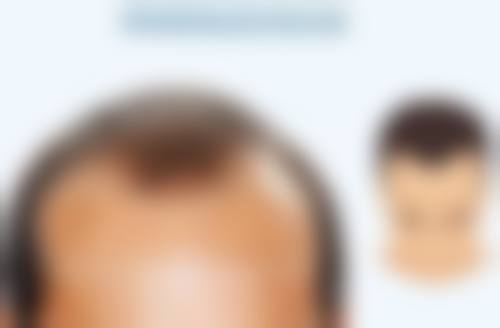 埋线双眼皮线掉变三眼皮咋办？切开修复重塑自然有神双眼，术后无痕效果佳 