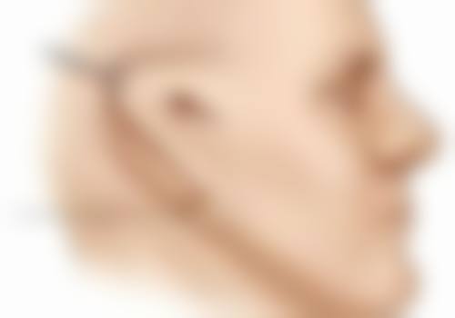 耳软骨隆鼻鼻尖显形怎么办？多维度修复方案与护理建议助你重塑自然美鼻 