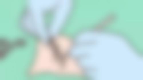 想做下巴整形却不知选哪种方法？假体、玻尿酸、自体脂肪等方式优势全揭秘 