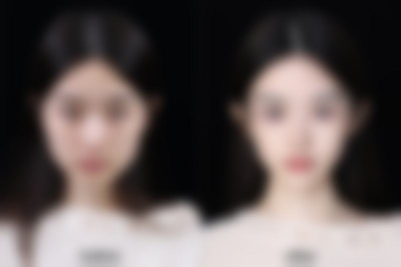 针对不同疤痕类型，分型修复有妙招