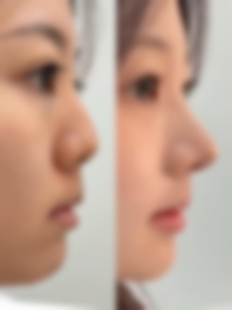 费书宇眼部整形手术水平怎么样可靠吗？