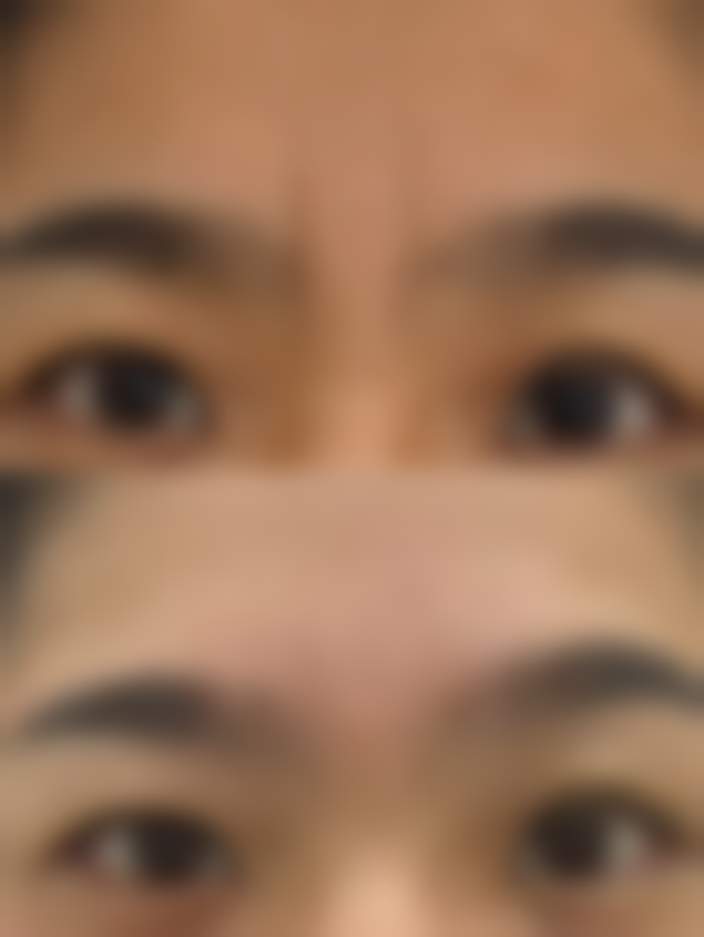 压宽双眼皮可改窄！正规医院多方式修复，自然效果与安全保障兼得 