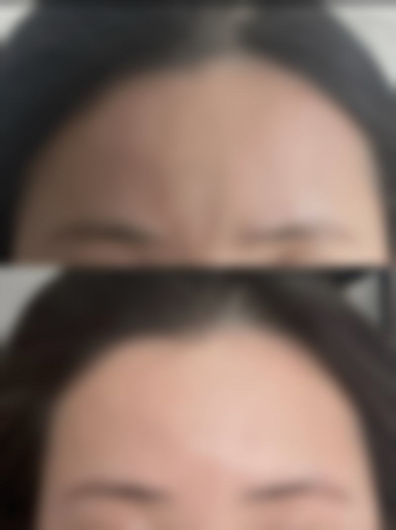 身上黑色疤痕去除攻略大揭秘！多种方法+专业医院助力，淡化色沉不是梦 