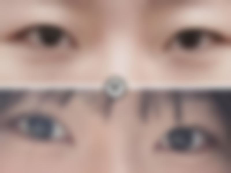 李祥仟眼部整形手术实例