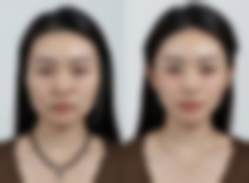 四、江苏盐城友谊整形实例