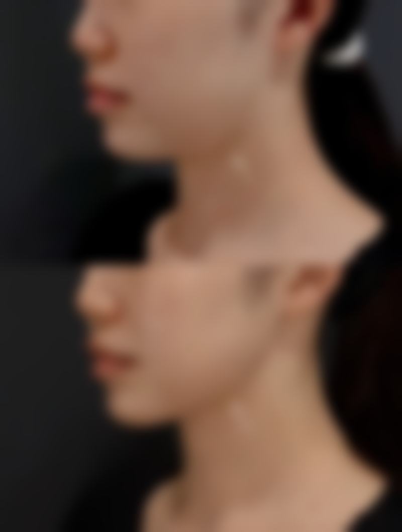 想快速去除黑眼圈和眼袋？注意事项要牢记