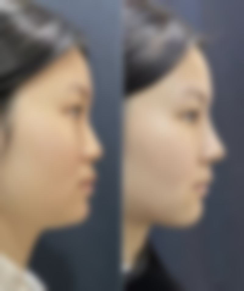 大腿吸脂后擦身体乳：综合护理成效好